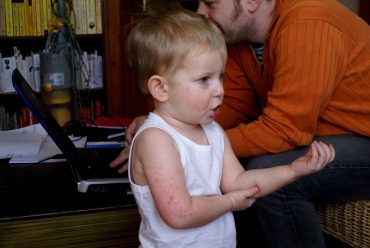 Eczema in kid
