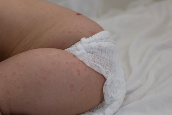 ผื่นผ้าอ้อมทำให้เด็กเจ็บและคัน