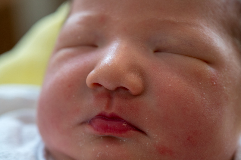 เรื่องของสิวทารก