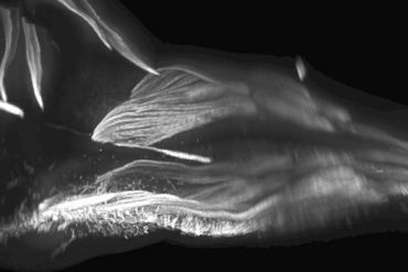 ทารกในครรภ์มีกล้ามเนื้อประหลาด