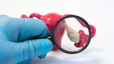 ภาวะถุงน้ำในรังไข่