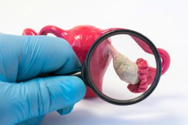 ภาวะถุงน้ำในรังไข่