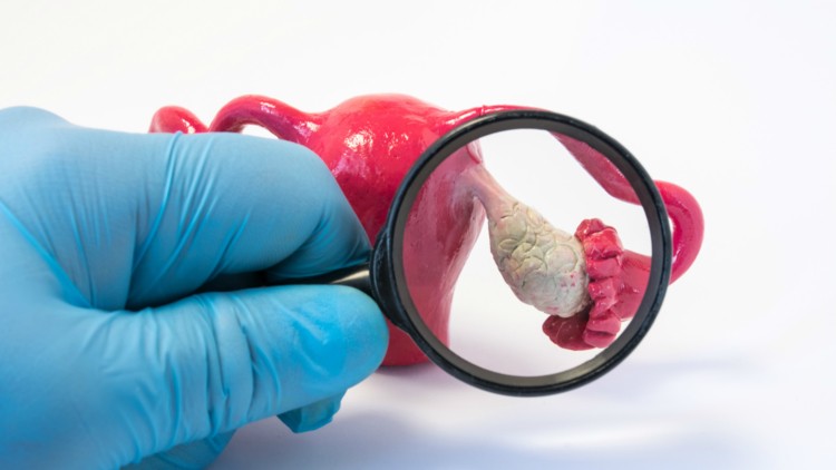 ภาวะถุงน้ำในรังไข่