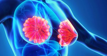 โรคเต้านมอักเสบ