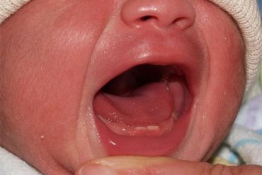 ลูกมีฟันแถม