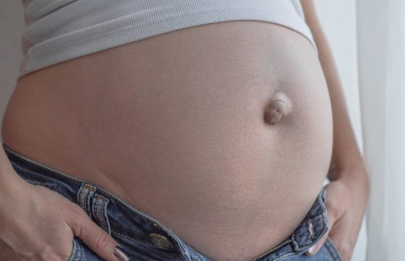 ภาวะไส้เลื่อนที่สะดือ