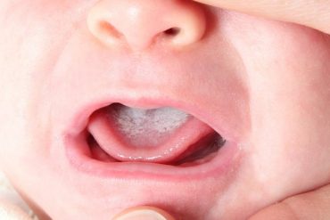 โรคเชื้อราในช่องปาก