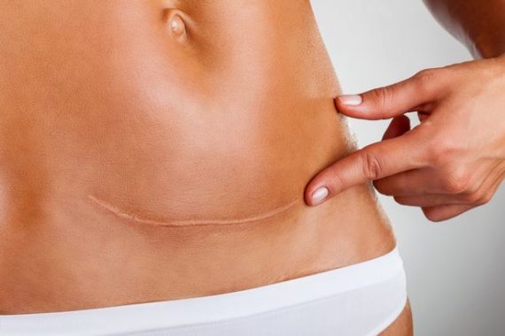 ท้องแรกผ่าคลอด ท้องสองคลอดเองได้ไหม