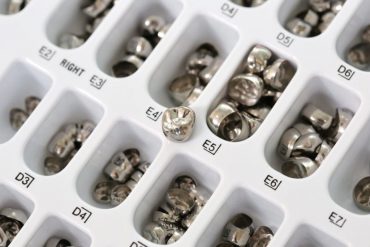 การครอบฟันเหล็ก