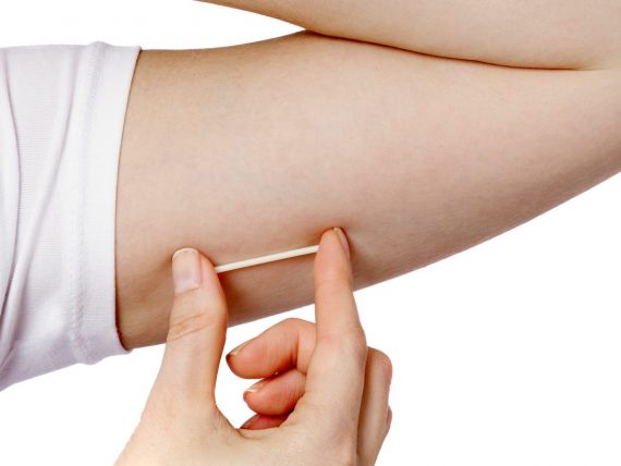 การฝังยาคุมดีไหม