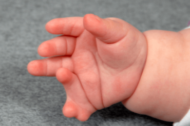 ภาวะนิ้วเกินในทารก