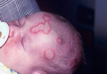 โรคชันนะตุในทารก