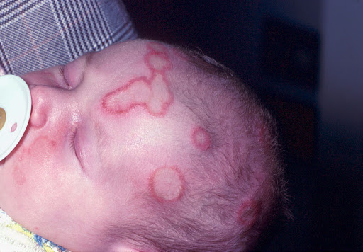 โรคชันนะตุในทารก