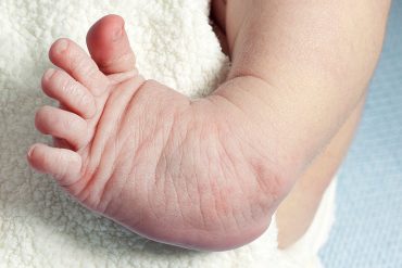 รู้จักโรคเท้าปุก