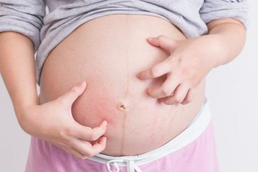 บรรเทาอาการคันระหว่างตั้งครรภ์