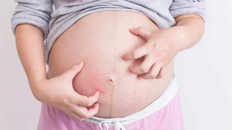 บรรเทาอาการคันระหว่างตั้งครรภ์