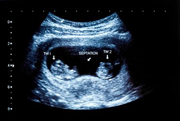 แฝดในท้องหายไปไหน