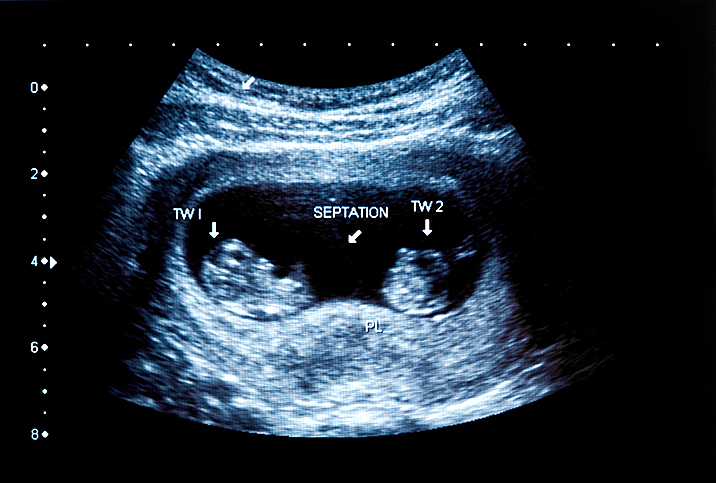 แฝดในท้องหายไปไหน