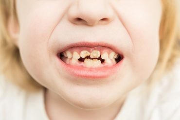 โรคฟันผุจากขวดนมในเด็ก